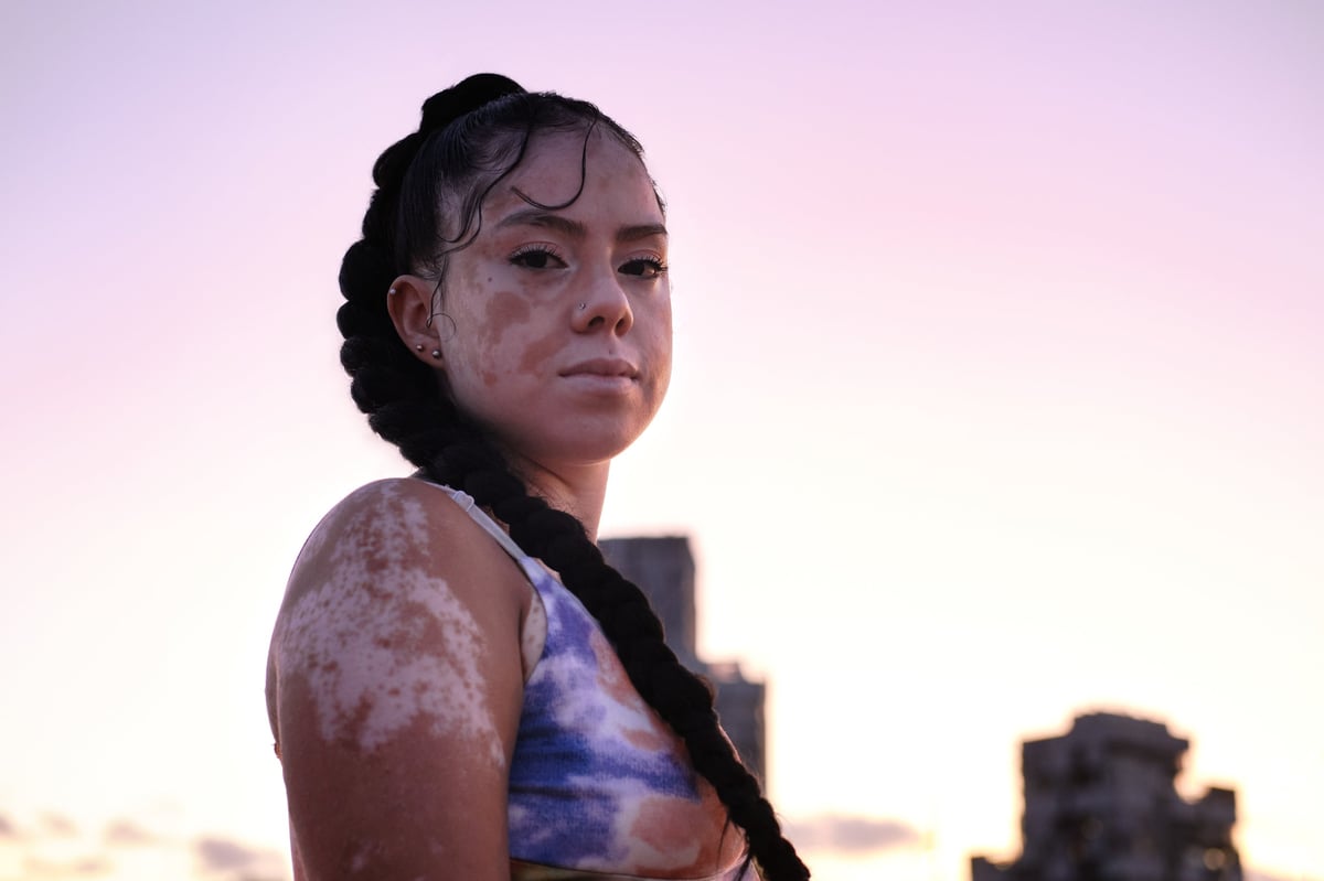 Mujer con vitiligo luciendo segura — PermatanMexico camuflaje profesional