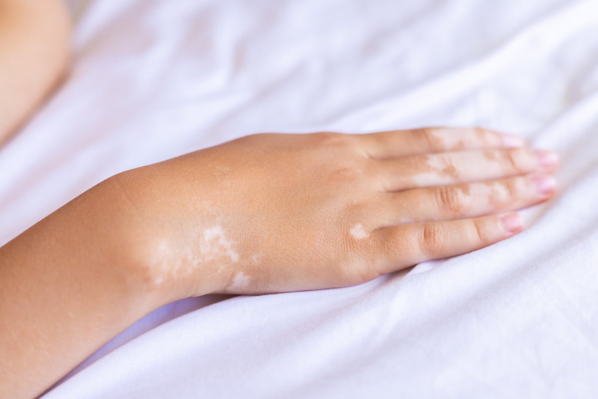 Mano con vitiligo — resultado de camuflaje profesional